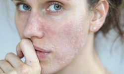 ‘Cilt yenileme işlemleri sterilize edilmiş ortamlarda gerçekleştirilmeli’