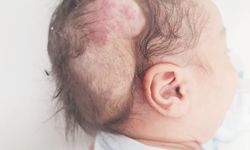 ‘Tümörün tamamını başarılı bir şekilde çıkardık’