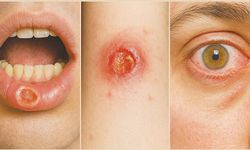‘Behçet hastalığı çoklu organ tutulumuna neden olur’