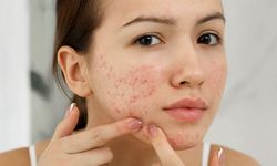 ‘Akne tedavisinde erken müdahale çok önemli’