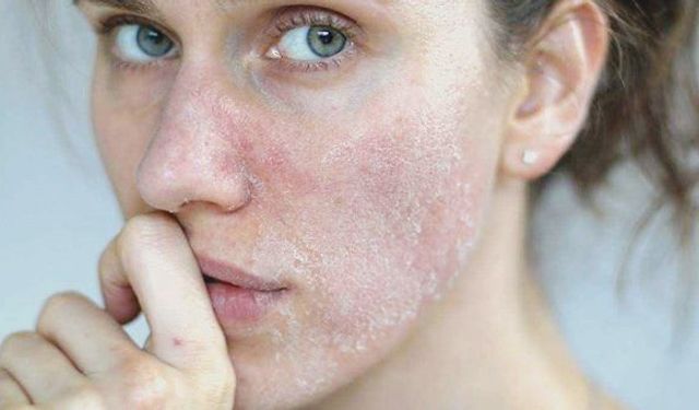 ‘Cilt yenileme işlemleri sterilize edilmiş ortamlarda gerçekleştirilmeli’