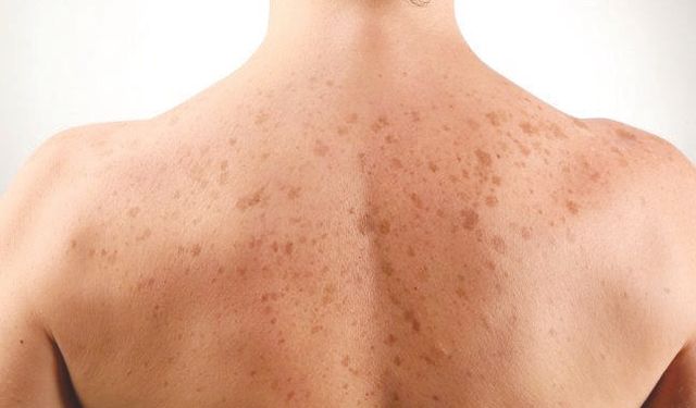 ‘Yanlış alışkanlıklar cildi sessizce yıpratıyor’