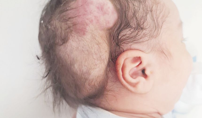 ‘Tümörün tamamını başarılı bir şekilde çıkardık’