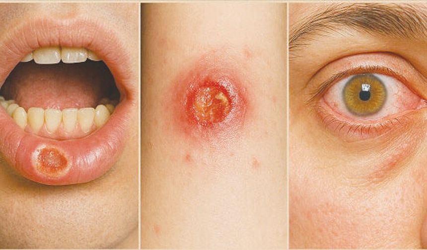 ‘Behçet hastalığı çoklu organ tutulumuna neden olur’