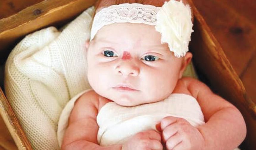 ‘Her hemanjiom tedavi gerektirmiyor’