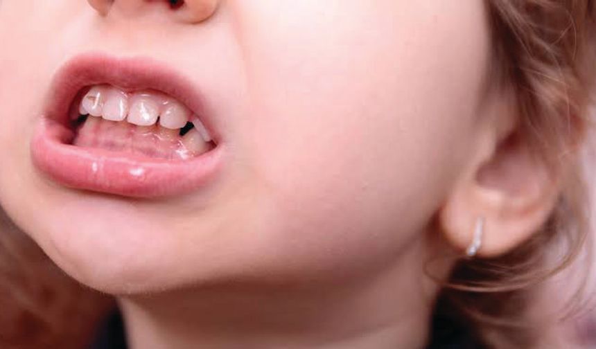 ‘Ağızdan nefes alma çene gelişimini olumsuz etkiler’